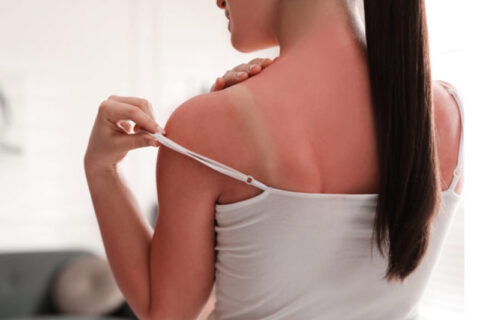 Woman with sunburned skin at home, closeup