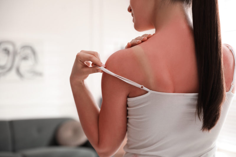 Woman with sunburned skin at home, closeup