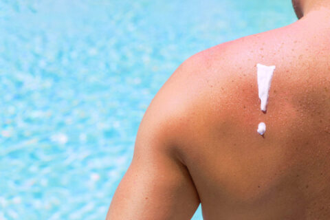 Cream applied on the back of a man, Melbourne FL