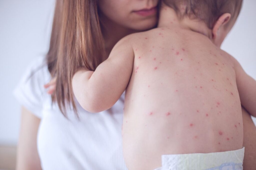 Mother holding baby with chicken pox welts